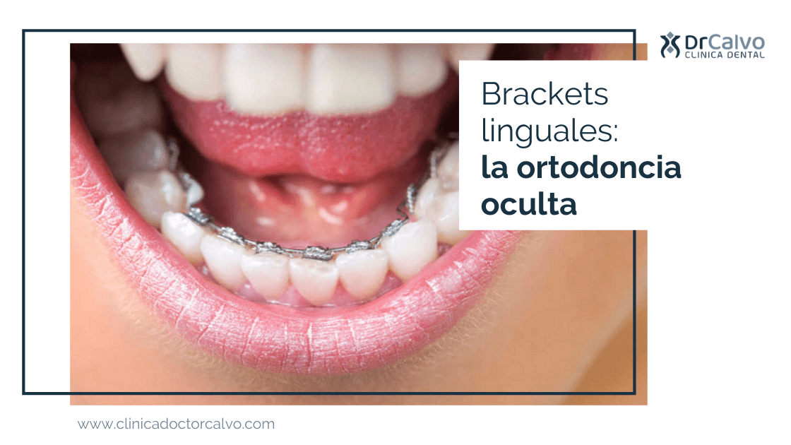 4 consejos para deportistas que llevan ortodoncia con brackets