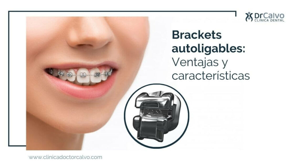 Brackets autoligables Ventajas y características. Clínica Doctor